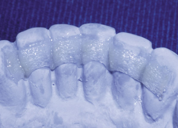 Ribbond's leno-woven fibers make it the most manageable dental reinforcement available. Ribbond has virtually no memory, does not unravel when cut and does not spread when adapted.