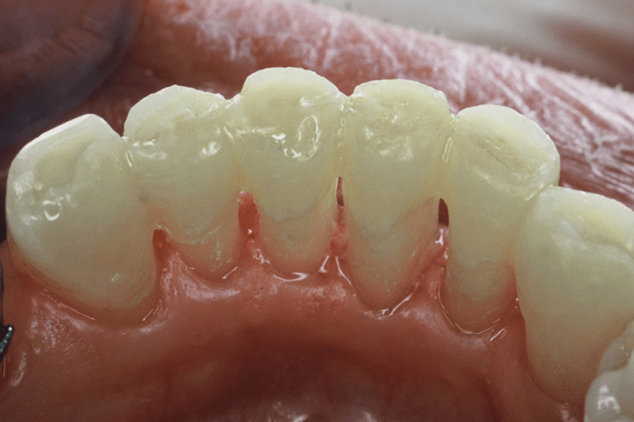 Periodontal splint