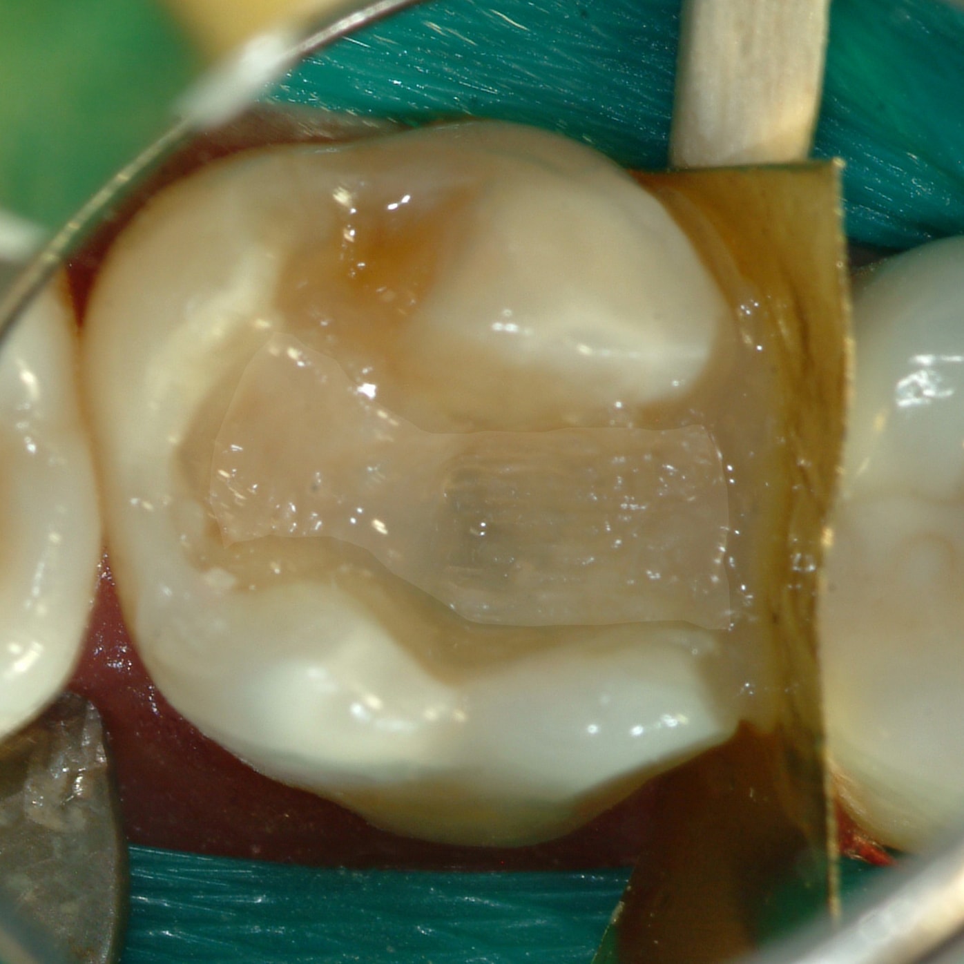 Composite restoration
