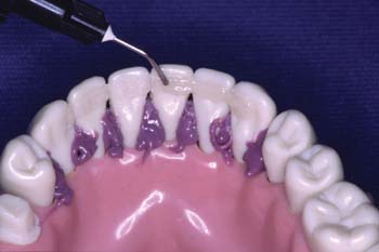 After curing the splint, cover the fibers with a layer of flowable composite to make the splint smooth. Do not use rotary instruments to polish the splint. The fibers must be covered with a thin layer of composite.
