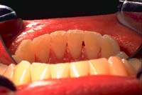 Fixed orthodontic retainers made with Ribbond are very esthetic, comfortable, and strong.