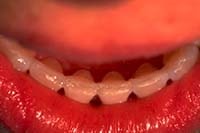 Orthodontic retainer