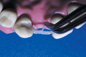 Wet second piece of Ribbond