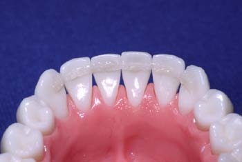 Remove excess composite and cure