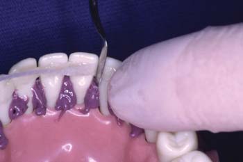 Adapt fibers interproximal