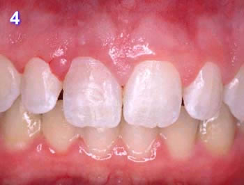 Trauma after Ribbond