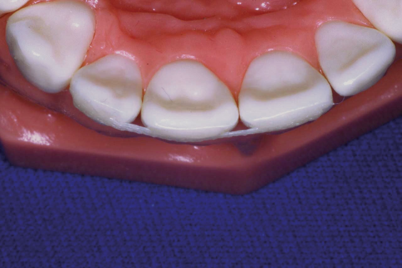 Trauma Stabilization Clinical Applications Ribbond