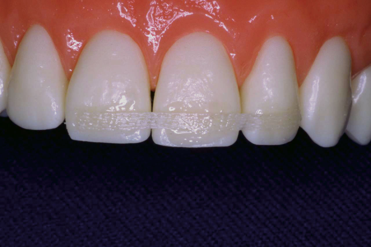 Trauma Stabilization Clinical Applications Ribbond