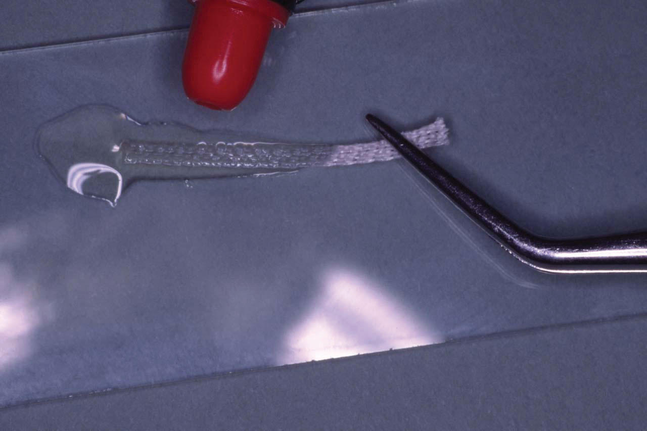 Trauma Stabilization Clinical Applications Ribbond