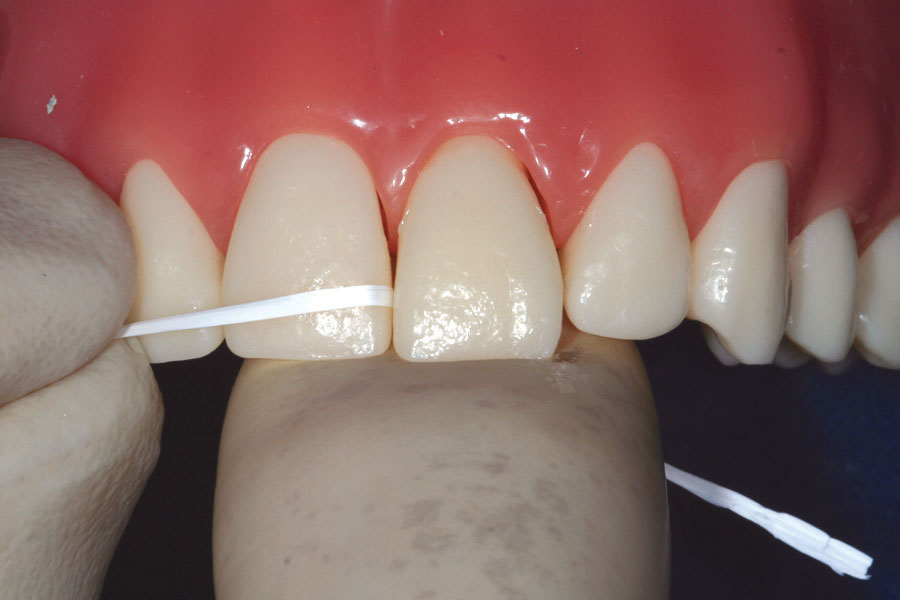 Trauma Stabilization Clinical Applications Ribbond